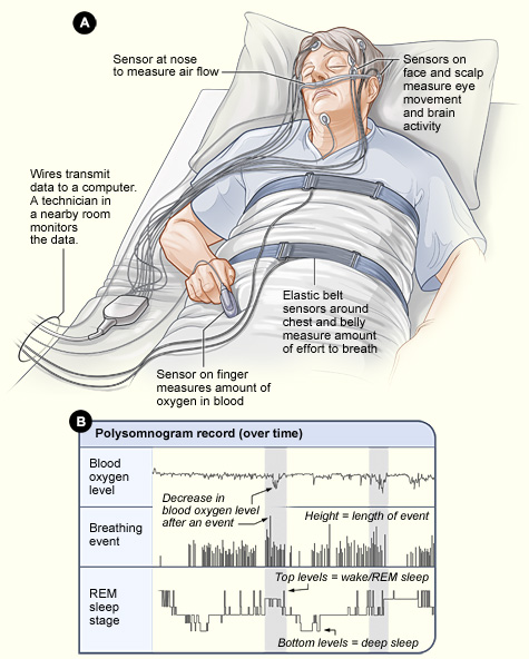 Illustration of a person undergoing a sleep study, with sensors measuring breathing, brain activity, eye movements and blood oxygen.